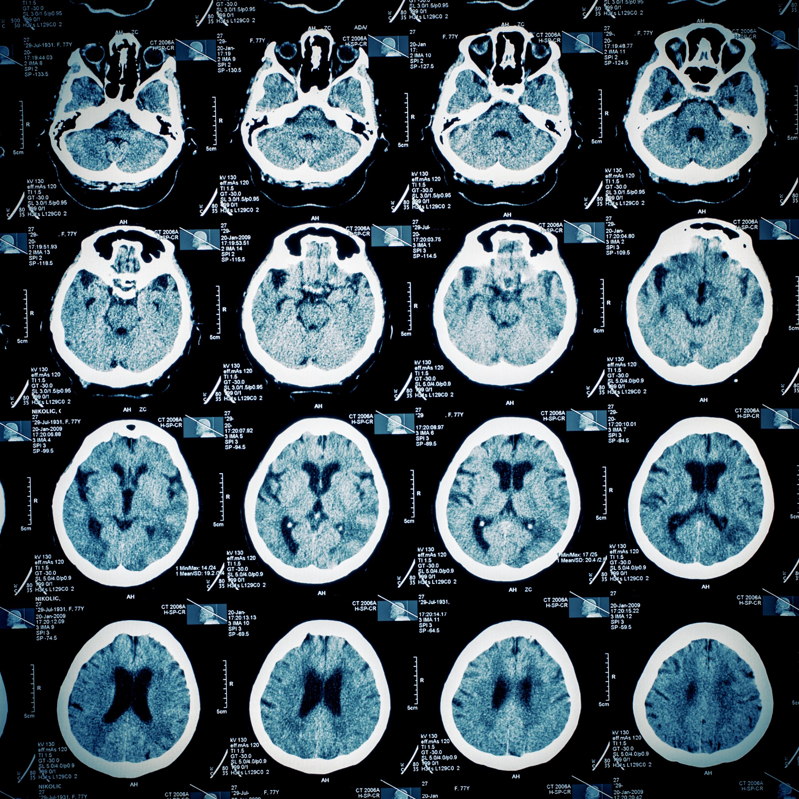 Pattern of human scull slices on MR imaging film.